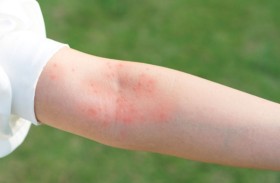 أنواع الطفح الجلدي الأكثر شيوعاً