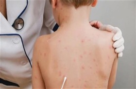 مرض نادر يثير القلق بعد عودته القوية