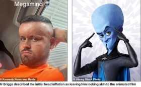 ذهب ليصبغ شعره فانتفخ رأسه كبالون عملاق