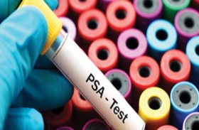 عامل قد يساعد على اكتشاف سرطان البروستات مبكرا