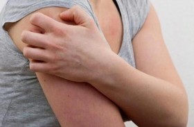 عقار ثوري يخفف أعراض مرض جلدي مؤلم