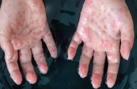   كندا ترصد 15 إصابة بجدري القردة في كيبيك