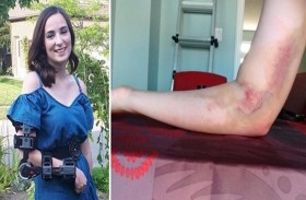 تبرع بالدم يتسبب لها بشلل دائم