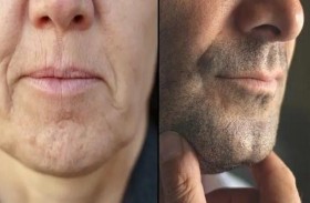 خيبة أمل... بعد معرفة سبب تشكل غمازات الذقن