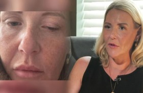 حقن تجميل مزيفة تسبب مرضاً نادراً