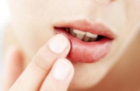 الحروق الشمسية تصيب الشفاه أيضاً