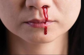 ما هي أسباب نزيف الأنف؟