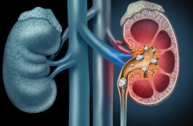 أطعمة يجب تجنبها للوقاية من حصى الكلى