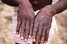 الصحة العالمية تحذر مجدداً من جدري القرود