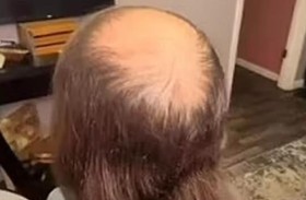 بتسريحة شعر... تنهي عقدة شقيقها مع الصلع