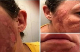 لهذا السبب تجنبي التقشير الكيميائي في المنزل 