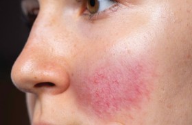 لماذا يزداد احمرار الوجه مع التقدم في العمر؟