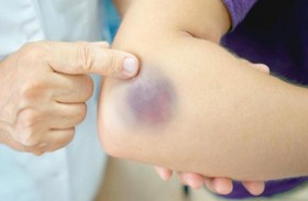 البقع الزرقاء أحد الأعراض المخيفة للسرطان 