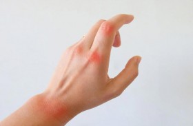 علامة التحذير الدقيقة في أصابعك لالتهاب المفاصل الروماتويدي!