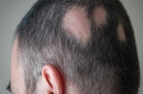 الصحة البريطانية تعتمد علاجا لداء «الثعلبة»