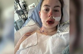 دواء اكتئاب يحرق الأعضاء الداخلية لشابة 