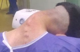 شاب يُصاب بانحناء كامل لرقبته على صدره!