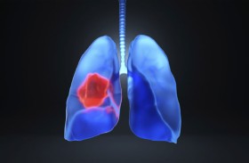 اكتشاف المحرك الرئيسي لتطور سرطان الرئة في مراحله المبكرة