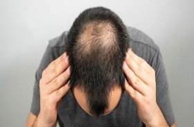 يدفع حياته ثمنا لـ عملية زرع شعر