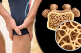 عقار  ميتفورمين علاج محتمل لهشاشة العظام