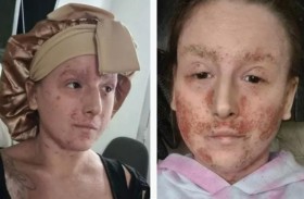 تعيش بـ «جلد سحلية» منذ طفولتها