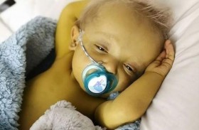 حالة نادرة تصبغ بشرة رضيع بالأصفر