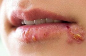 هربس الوجه فيروس يعود لـ5 آلاف سنة