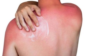 أعراض حساسية الشمس وسبل الوقاية منها