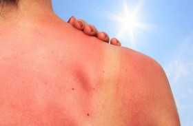 خبراء يحذرون.. حيل خطيرة لحروق الشمس