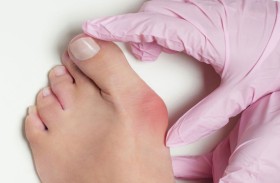 طبيب يوضح سبب تورم إبهام القدم