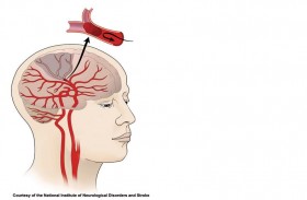 التغييرات الغذائية الستة لتقليل خطر الإصابة بسكتة دماغية