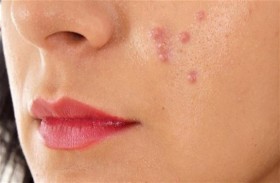 هل علاج حب الشباب آمن للحامل؟